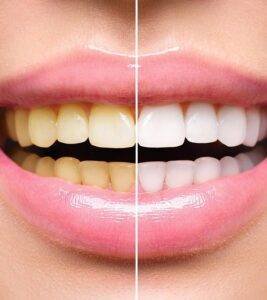 dirty teeth , stained teeth, dental clinic near me, dental hygienist bradford, teeth whitening bradford , Get Rid of Badly Stained Teeth