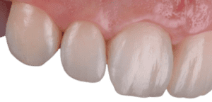 ideal perfect teeth shape, teeth contouring, teeth reshaping, wedding smile makeover, cosmetic and facial treatment