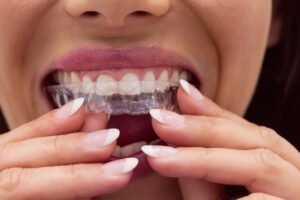Invisalign Braces